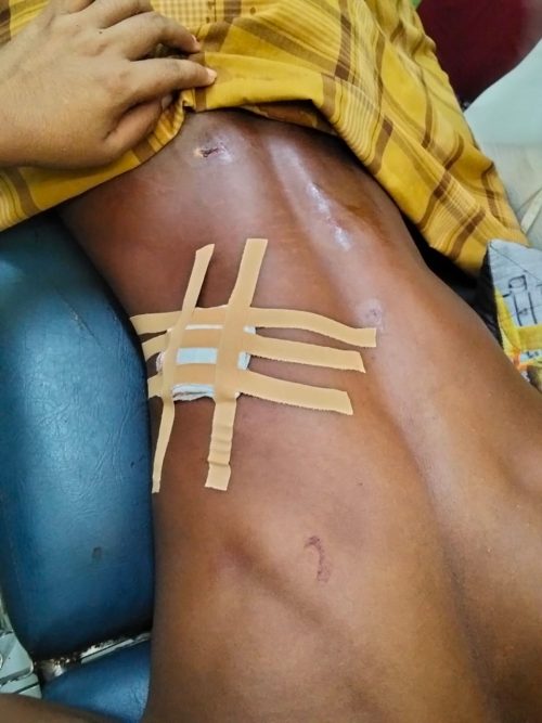 Bagian belakang luka pembacokan pada Rangga M. Saleh (Yoga). (Fen/Ist)